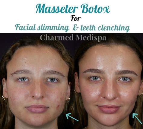 botox  masseters charmed medispa