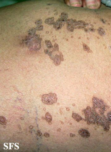 porokeratosis segmental porokeratosis nc commons