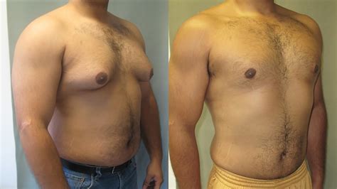 Gynecomastia Surgery in Dubai: Expert Care and Results - Bioneers Live