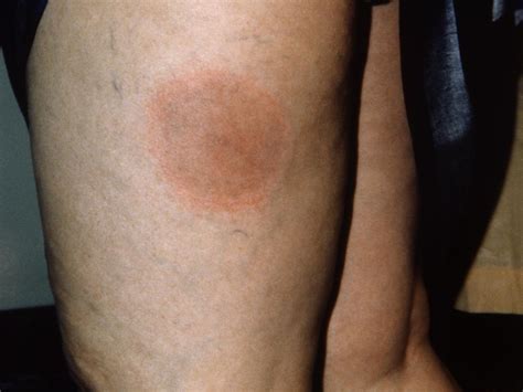 Lyme Disease Tick Bite Bruise at Eugene Little blog