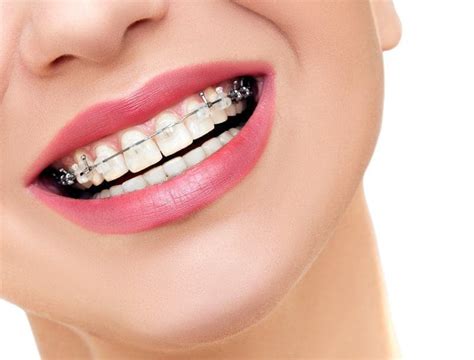 understanding  cost breakdown  braces parker orthodontics
