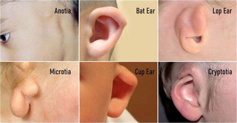 Developmental Disorders of the Ear - MEDizzy