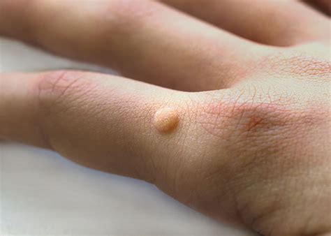 Common Warts And How They're Treated Dermatology Treatment, 55% OFF