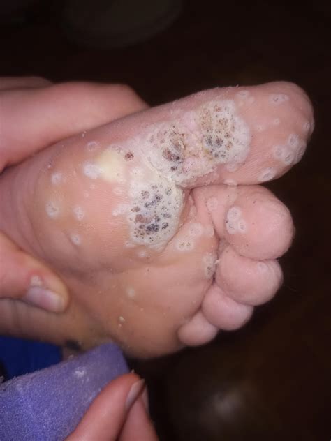 I think this is severe. : r/Warts