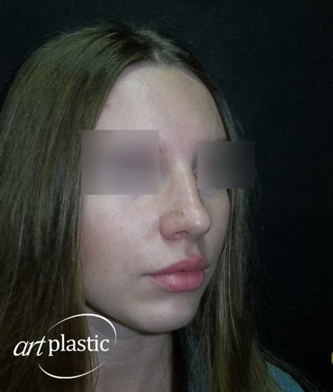 Ринопластика / Фото / Альбом №74 | Клиника Art-Plastic