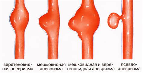 Подвздошная артерия: где находится, ветви и функции
