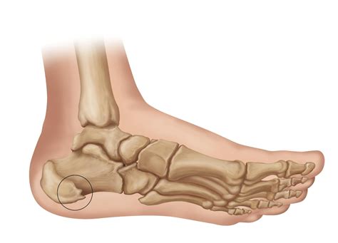 Causes Bone Spur On Top Of Foot Outlet | emergencydentistry.com