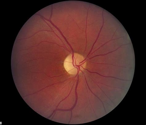 Optometry Atlas: Optic nerve conditions | Viewpoint
