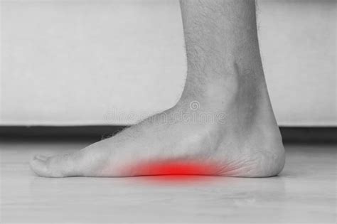 Foot Pain because of Strong Flat Feet Also Called Pes Planus or Fallen ...