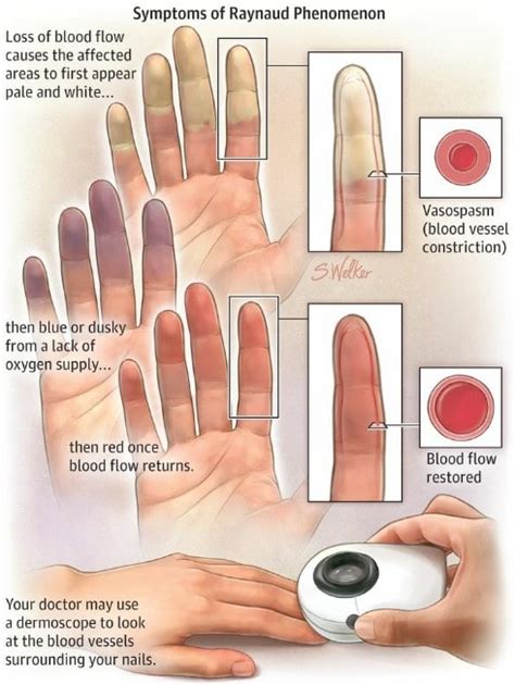 Scleroderma Causes Symptoms Prognosis Diagnosis CREST Syndrome