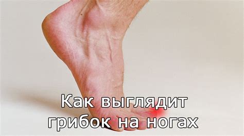 Как выглядит грибок на ногах - YouTube
