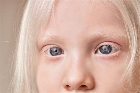 Albino White People With Red Eyes