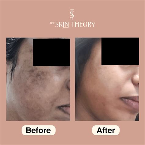 Skin theory Clinic Dermatology & Aesthetics by Dr. Guruvani Ravu - The