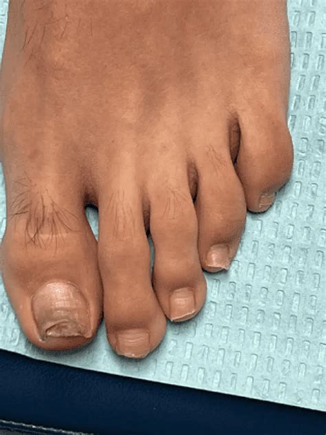 Toenail Fungus for Lincoln Park, Chicago, IL | Lincoln Park Podiatry