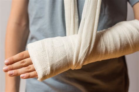 Broken Arm: How to Treat and Eat for a Speedy Recovery? - Good Health Plan