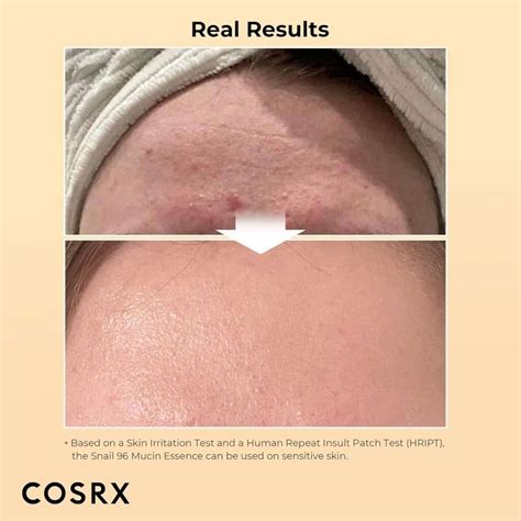 COSRX Snail Mucin Review Before and After: My Honest Take (With Results)