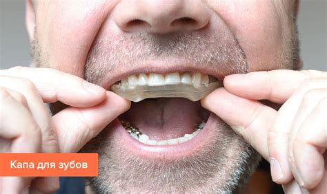 Лечение бруксизма — препараты и аппараты на Startsmile.ru