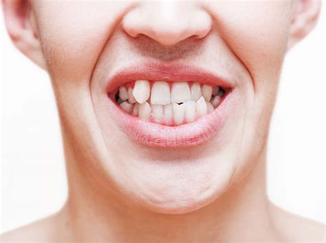What Causes a Snaggletooth? | SmartSmileCo
