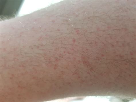 Any idea what this rash may be. On lower legs and ankles. 32 male, also