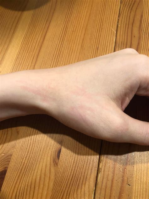 I usually get itchy ness and redness here. Is this hives or some