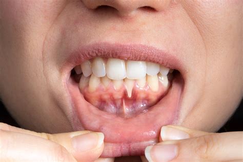 Gum Recession: Causes, Symptoms, And Remedies