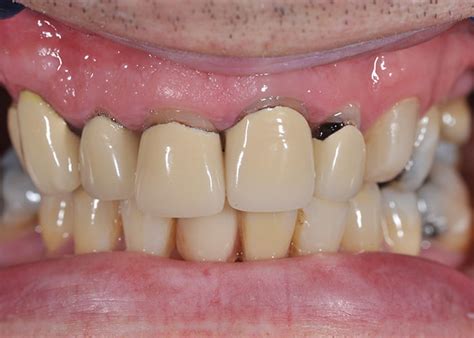 Typical dental bridge problems you should never ever ignore