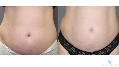 Lose Belly Fat Fast - YouTube