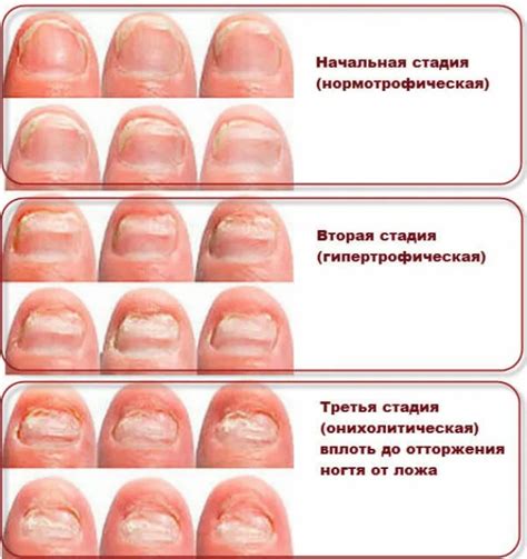 Как выглядит грибок ногтей: основные симптомы