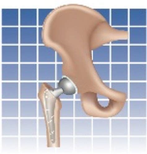 Guidelines for Hip OA - Arthritis Advisor