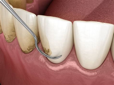 periodontal treatment  stock  pictures royalty