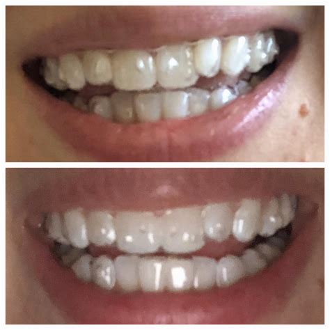 Only on tray 4/25 and already seeing positive changes, especially on