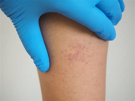 Purpura Trombocitopenica Trombotica - Púrpura trombocitopênica trombótica (PTT) - SPES Hematologia e terapia ...
