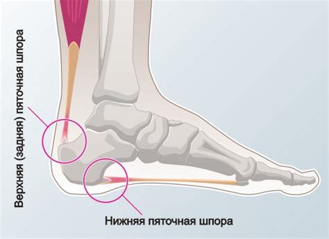 Пяточная Шпора (Плантарный Фасциит): Появление подошвенного фасциита ...