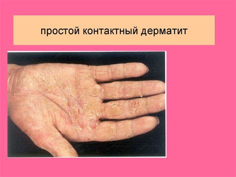 Дерматиты. Классификация - презентация онлайн