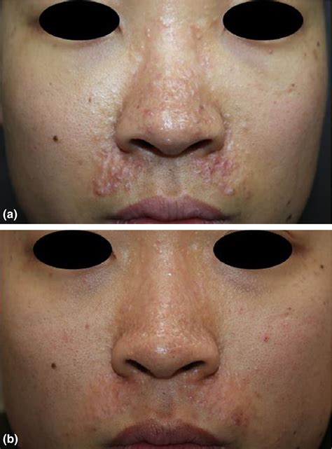 Trichoepithelioma
