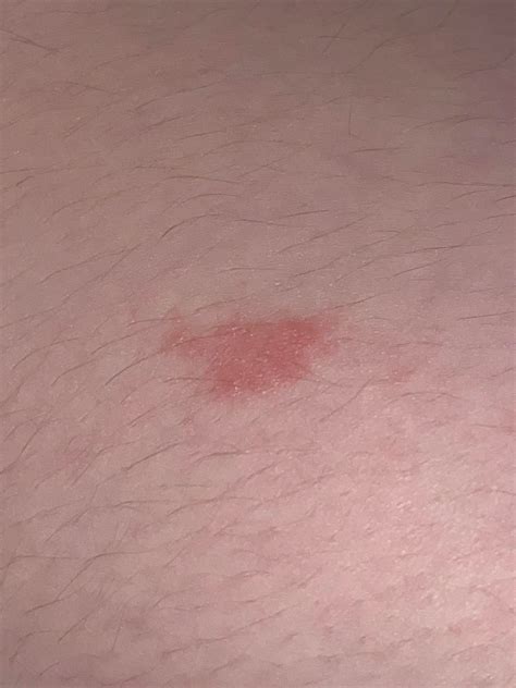 New random red spot on thigh : r/medical_advice