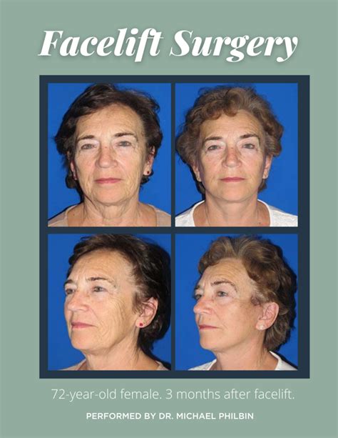 facelift  patrick drago blog