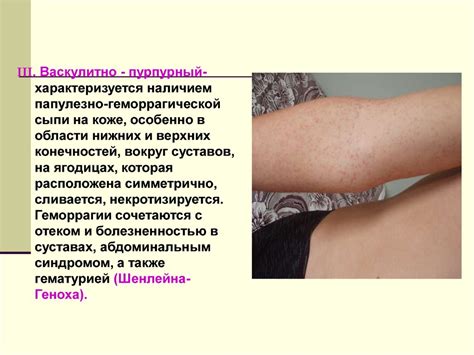 Геморрагические диатезы - презентация онлайн