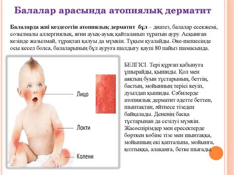 Атопиялық дерматит - презентация онлайн