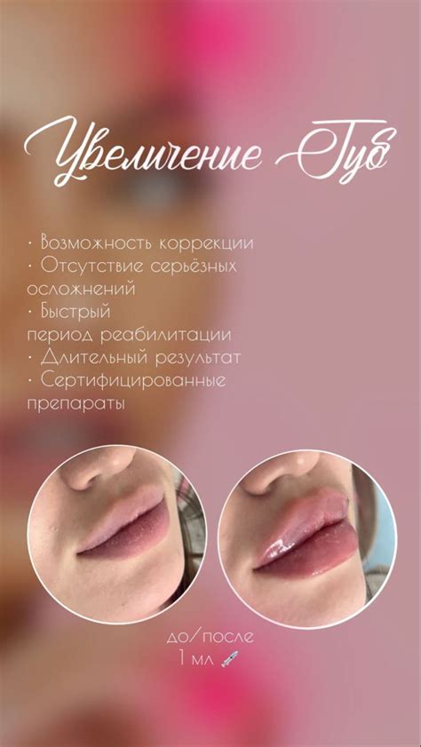 Увеличение губ, 2024