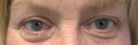 eye loss      carolina eye prosthetics