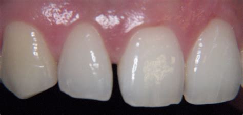 Dente Separado No Meio - → Dente separado: como fechar os espaços? - Dr. Wilson Correia