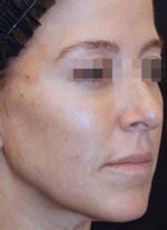 BeautiFill Before and After | DrC360 | New Providence, NJ