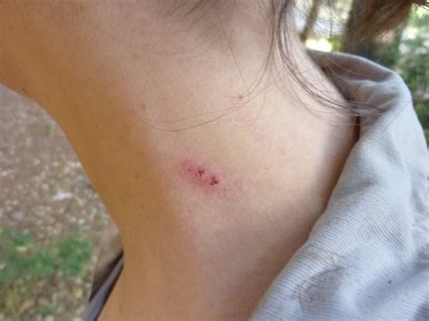 Disease transmission