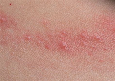 contact dermatitis   risk factors