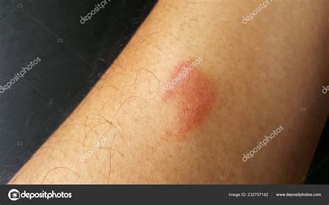Imagens De Picada De Centopeia