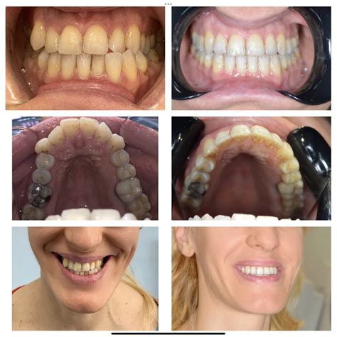 Алайнери Invisalign или брекети? Как да изберем?