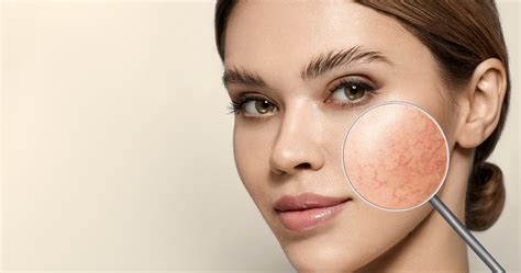 Acne vs Rosacea - Whats The Difference? | Charette Cosmetics