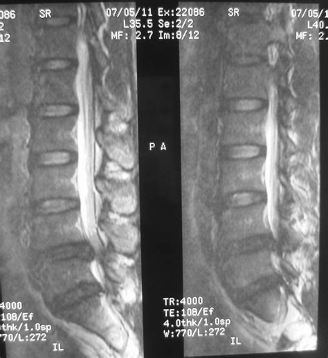 HUNG NGO TAN, MD: 7-5-2011,L4-5LSS,L5-S1DH