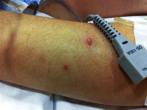 melioidosis melioidosis  pulmonary melioidosis infection